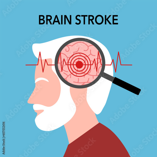 Magnifying human brain stroke problem in flat design. Brain disease.