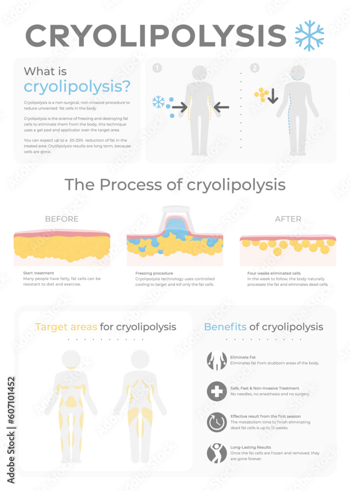 Cryolipolysis vector infographic.
Graphics of the treatment with tissues, skin layers and reduction of fat cells. Body fat problems areas pictogram and weight loss icon. Fat freezing benefits icon set Cryolipolysis vector infographic.
Graphics of the treatment with tissues, skin layers and reduction of fat cells. Body fat problems areas pictogram and weight loss icon. Fat freezing benefits icon set