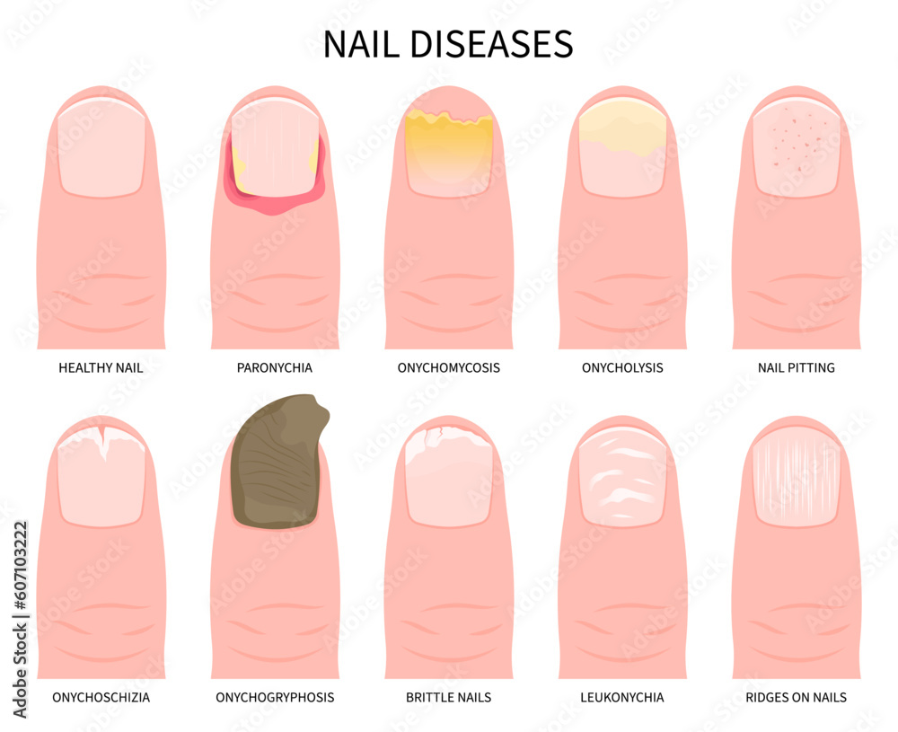 nail pain or onycholysis yellow peeling toes health and Beau's line