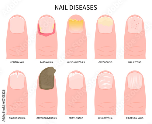 nail pain or onycholysis yellow peeling toes health and Beau's line syndrome white bands ridge damage of split care Tinea liver zinc iron crumbly fissure bed matrix spots big spoon kidney cancer photo