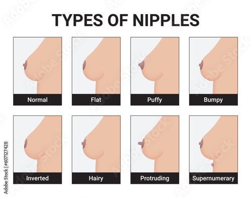 Types of Nipples Medical Vector Illustration
