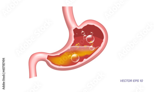 Human stomach problems, Gastrointestinal diseases. Common Digestive Disorders. Poor Digestive conditions. How right medication keep your stomach healthy. Student biology study material images.