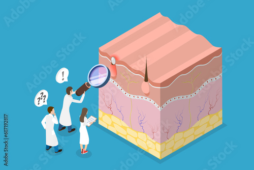 3D Isometric Flat Vector Conceptual Illustration of Acne Vulgari, Formation of Skin Pimple