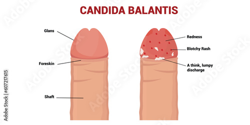 Candida Balanitis Vector Illustration.    Healthy penis and infected