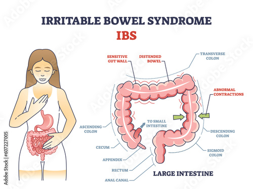 Irritable bowel syndrome or IBS as digestive health problem outline diagram. Labeled educational scheme with body gastric tract disease and stomach organ illness vector illustration. Intestine anatomy