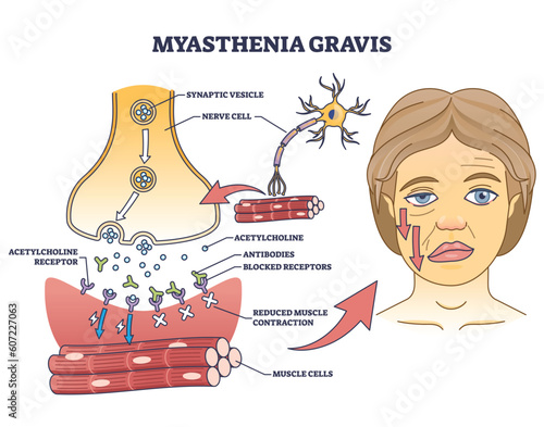 Myasthenia gravis as autoimmune, neuromuscular disease outline diagram. Labeled educational medical scheme with skeletal muscles weakness symptoms vector illustration. Anatomical illness explanation.