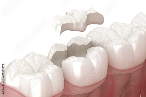 Fototapeta Naklejka Na Ścianę i Meble -  Onlay ceramic crown fixation over tooth. 3D illustration with transparent background