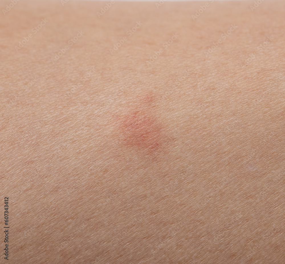 Fotografie insect bites on the skin as a background.