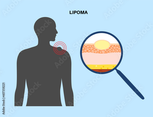 Lipoma medical poster