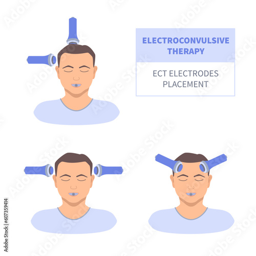 Electroconvulsive therapy for severe depression and schizophrenia treatment. ECT electrodes placement on a male patient. Brain stimulation equipment for major depressive disorders. Vector illustration