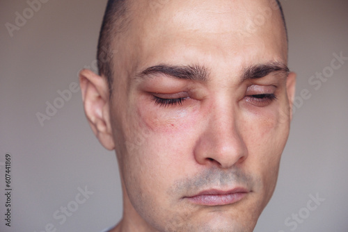 Caucasian man has angioedema around the eyes caused by allergic reaction to agents such as insect bites, foods, or medications. Swollen face, close up.