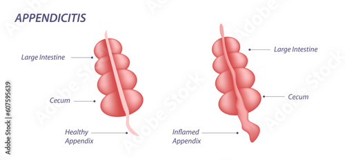 Appendicitis is an inflammation of the appendix. Appendicitis inflammation pain vector illustration. Abdominal lower belly pain  photo