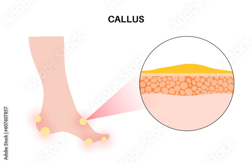 Callus and corns