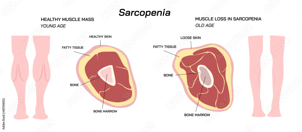 Loss of muscle mass and strength Sarcopenia vector illustration. Difference between Young age muscle mass and Old age muscle mass. 