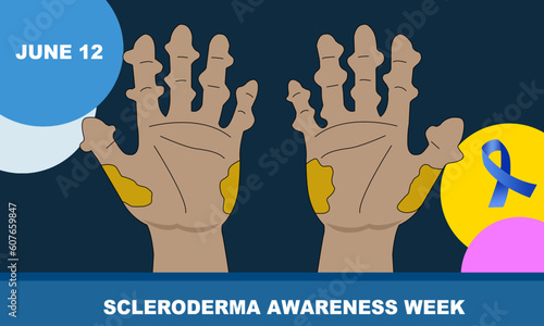 a pair of hands with a rare disease called SCLERODERMA. an autoimmune connective tissue and rheumatic disease that causes inflammation in the skin and other areas of the body. SCLERODERMA AWARENESS