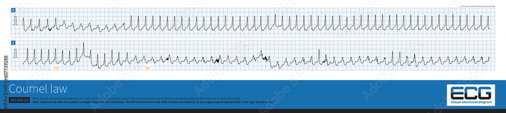 In atrioventricular reentrant tachycardia, sudden bundle branch block with a prolonged RR interval of more than 35 mm indicates that the bypass is on the side of the bundle branch block.