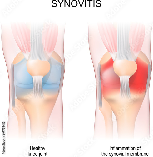 Synovitis. Human Knee joint anatomy