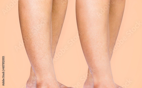 Image compare woman legs result before and after leg hairs removal, skin care and beauty concept.