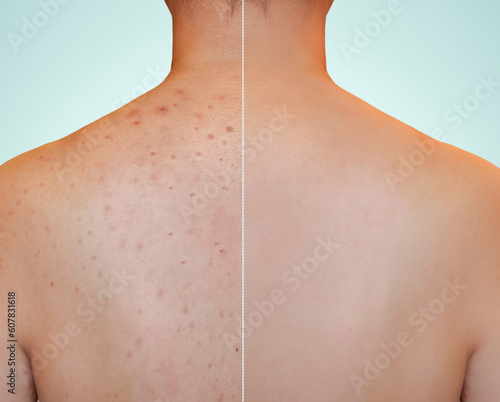 Closeup young woman\'s back with red rash skin and acne scar on especially on shoulder. Image compare before treatment on dark spot acne pimples scar to clean clear smooth skin after treatment.