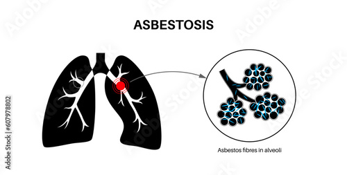 Asbestosis lung disease