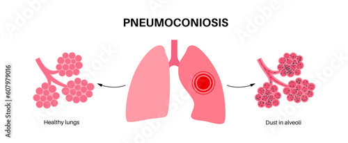 Pneumoconiosis lung disease