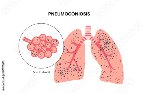 Pneumoconiosis lung disease