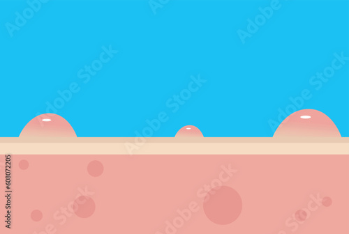 Acne Pimple treatment inflammation associated with pimples. On a blue background. The structure of the skin acne scar. Medical beauty skin care concept