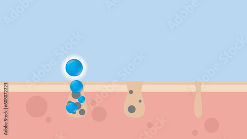 Acne Pimple treatment inflammation associated with pimples. On a blue background. The structure of the skin acne scar. Medical beauty skin care concept