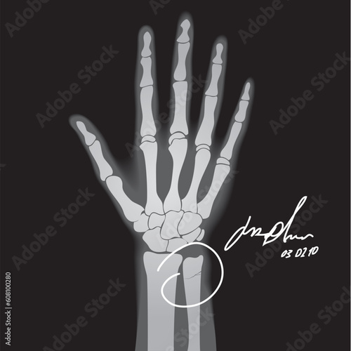 Vector illustration of brooken hand. X-ray. photo