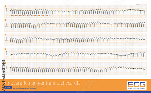 фотографія A 1-month-old boy with recurrent supraventricular tachycardia experienced cardiac arrest after a doctor administered 3mg of ATP
