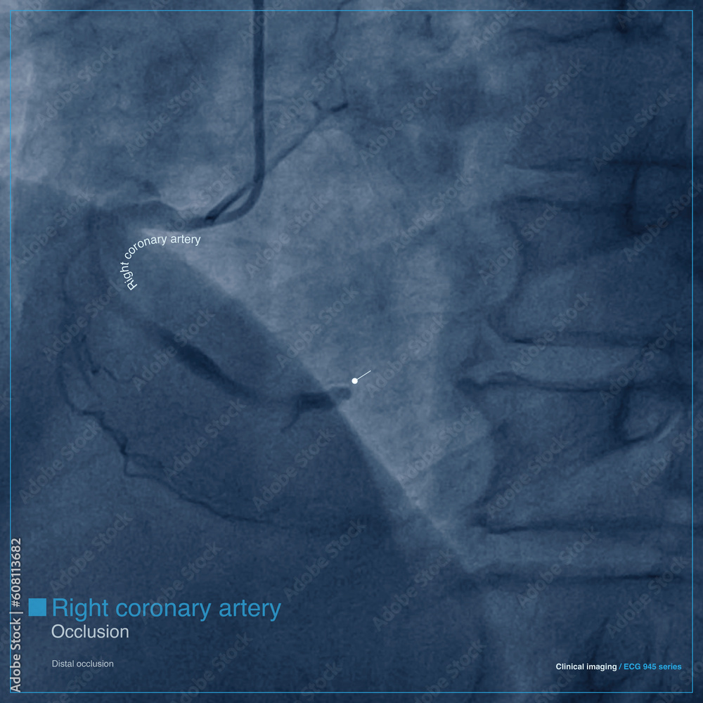 Male, 68 years old, chest pain for 7 hours. Coronary angiography