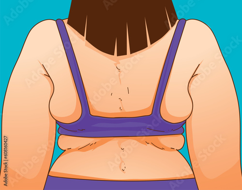 A woman's body with problem areas. Back fat. Bra bulge. Medical infographic. Healthcare illustration. Vector illustration. 