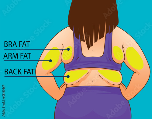 A woman's body with problem areas. Back fat. Bra bulge. Medical infographic. Healthcare illustration. Vector illustration. 