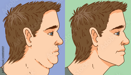 Double chin. The man with the age problems on her face. Before, after. Face correction. Healthcare illustration. Vector illustration. 