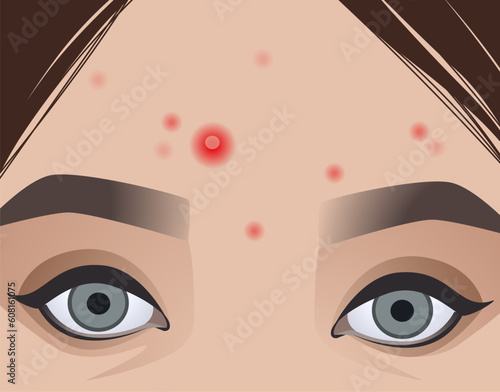 Skin problems.  Acne problems, damaged skin. Healthcare illustration. Vector illustration.