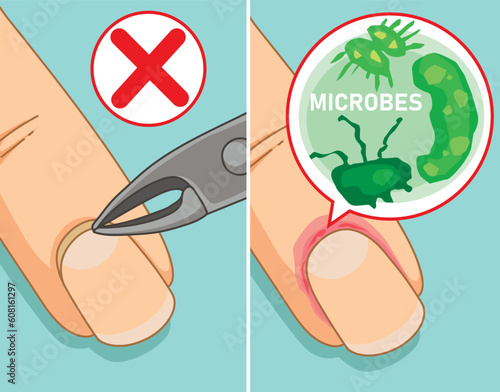 How to do a manicure. How to remove the cuticle. Manicure mistakes. Woman nail with infection. Healthcare illustration, vector illustration.