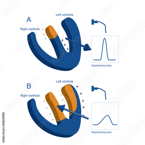 The normal ventricular depolarization starts from the left interventricular septum, then extends to the apex, and finally to the base of the heart. The repolarization extends from the apex to the base photo