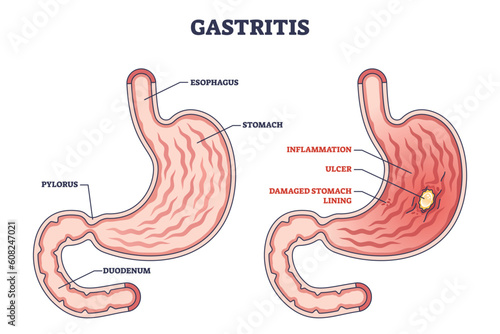 Gastritis as stomach lining inflammation illness and disease outline diagram. Labeled educational gastric problem with burning and pain in intestinal tract vector illustration. Medical structure. photo