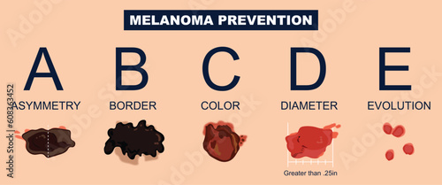 Melanoma skin moles characteristics prevention infographic illustration