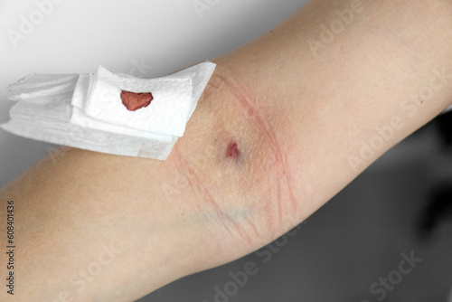 A bruise from a needle on the arm. Place a blood test from a vein on the arm. Medical sterile Plaster. Photo