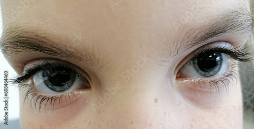 Tableau sur toile children's eye with dilated pupils. High quality photo