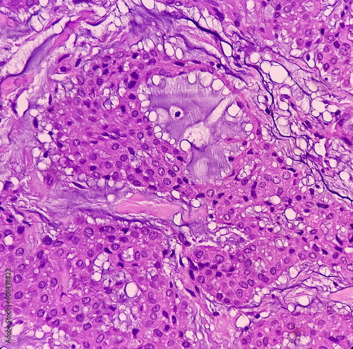 Soft tissue (biopsy).Glomus tumor or Paragangliomas. Microscopically show soft tissue, feature of Glomus tumor, benign but locally invasive tumors.