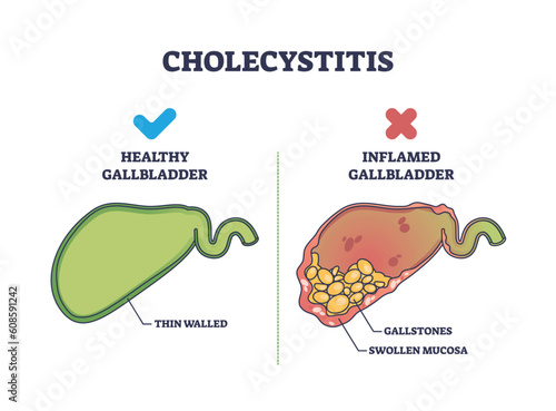Cholecystitis as inflamed gallbladder compared with healthy outline diagram. Labeled educational scheme with swollen mucosa and gallstones in digestive tract vector illustration. Stomach disease.