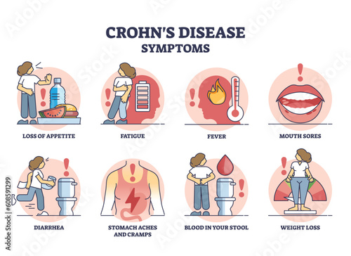 Crohns disease symptoms from inflammatory bowel illness outline diagram. Labeled educational medical list of problems from digestive tract inflammation vector illustration. Pain and diarrhea cause.