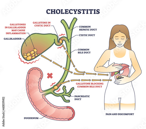 Cholecystitis as gallbladder inflammation from blocked gallbladder outline diagram. Labeled educational scheme with medical disease in digestive tract from gallstone vector illustration. Duct anatomy photo