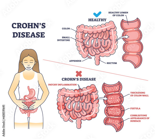 Crohns disease as inflammatory bowel problem explanation outline diagram. Labeled educational medical comparison with stomach illness and healthy colon, small intestine and gut vector illustration.
