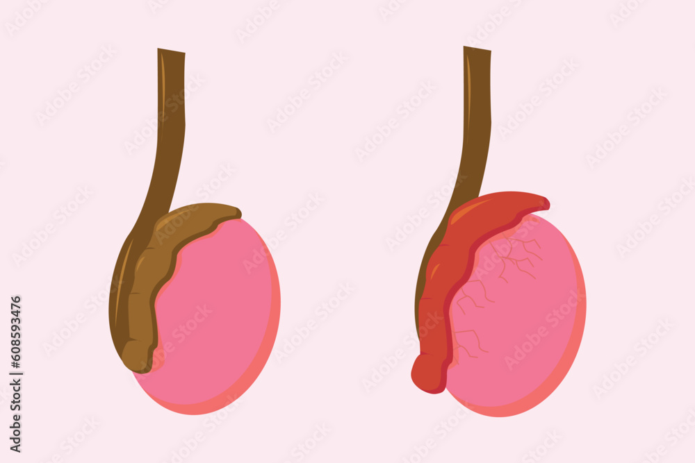 vetor-de-illustration-of-epididimitis-inflamasi-epididimis