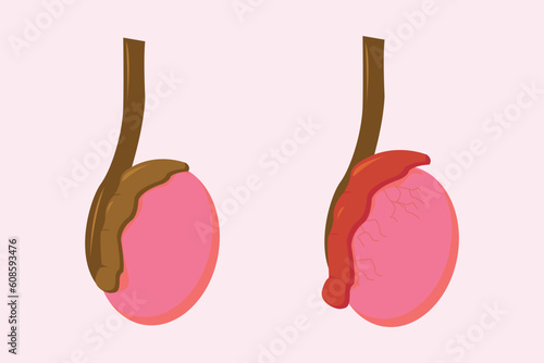 illustration of epididimitis (inflamasi epididimis). Epididymitis is inflammation of the epididymis which is generally caused by a bacterial infection photo