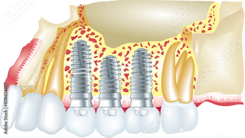 Dental implants