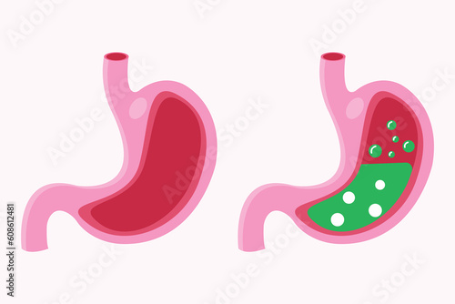 illustration of pyrosis stomach and nausea stomach. Pyrosis fire disorder, gastric acid reflux. Stomach medical illustration set